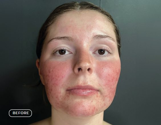 Haut vor dem Oxygen RX Treatment mit Enzym-Peeling
