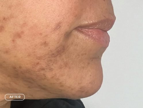 Haut nach der Behandlung von Hyperpigmentierung
