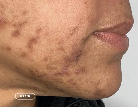 Haut vor der Behandlung von Hyperpigmentierung